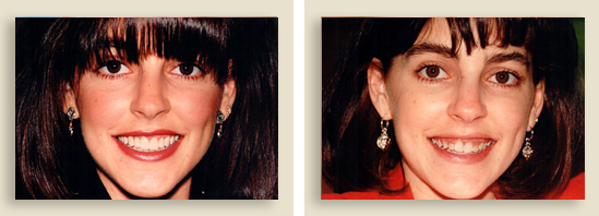לפני ואחרי השתלת שיניים לנשים